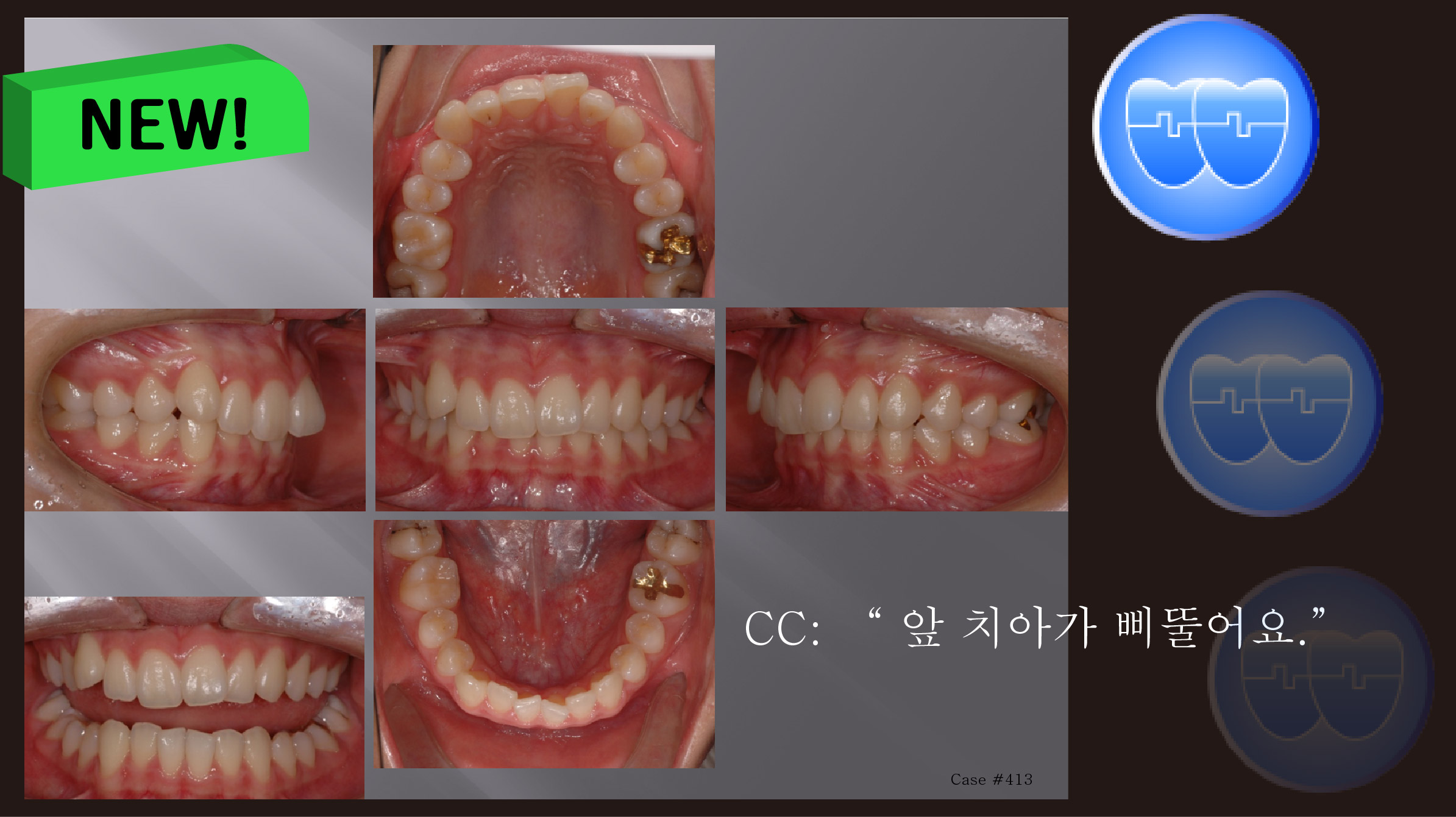 교정 Case 413.  U5 발치 Only, U5 발치의 매력, Deepbite, Sem #6