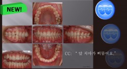 교정 Case 413.  U5 발치 Only, U5 발치의 매력, Deepbite, Sem #6