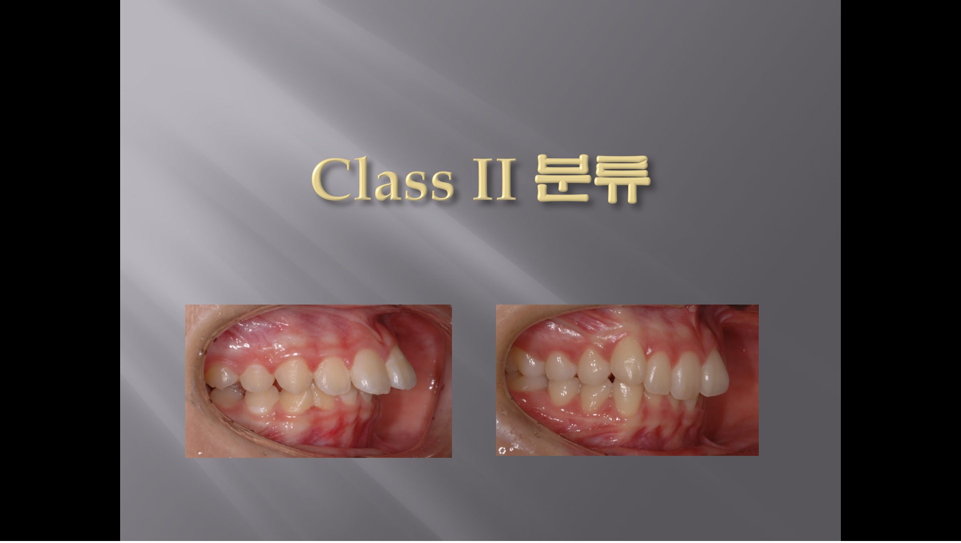 (강의 36) Sem #15  Class II. (Part I. Diagnosis and Characteristics)