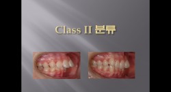 (강의 36) Sem #15  Class II. (Part I. Diagnosis and Characteristics)