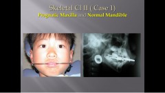 (강의 36) Sem #15  Class II. (Part II. Treatment Concepts and Methods)