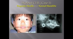 (강의 36) Sem #15  Class II. (Part II. Treatment Concepts and Methods)