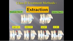 (강의 36) Sem #15  Class II. (Part III. Treatment Methods-Extraction)