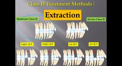 (강의 36) Sem #15  Class II. (Part III. Treatment Methods-Extraction)