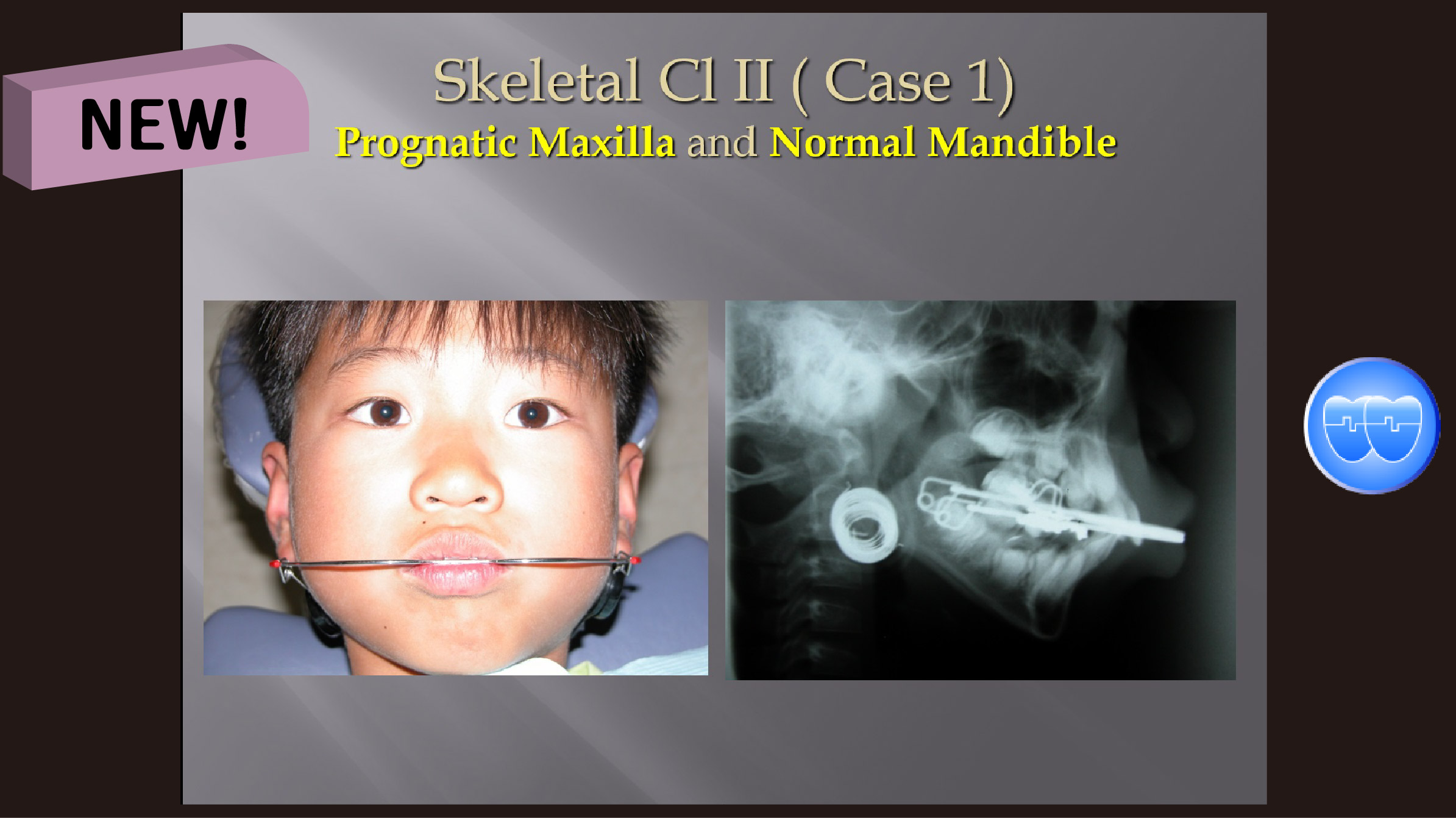 (강의 36) Sem #15  Class II. (Part II. Treatment Concepts and Methods)