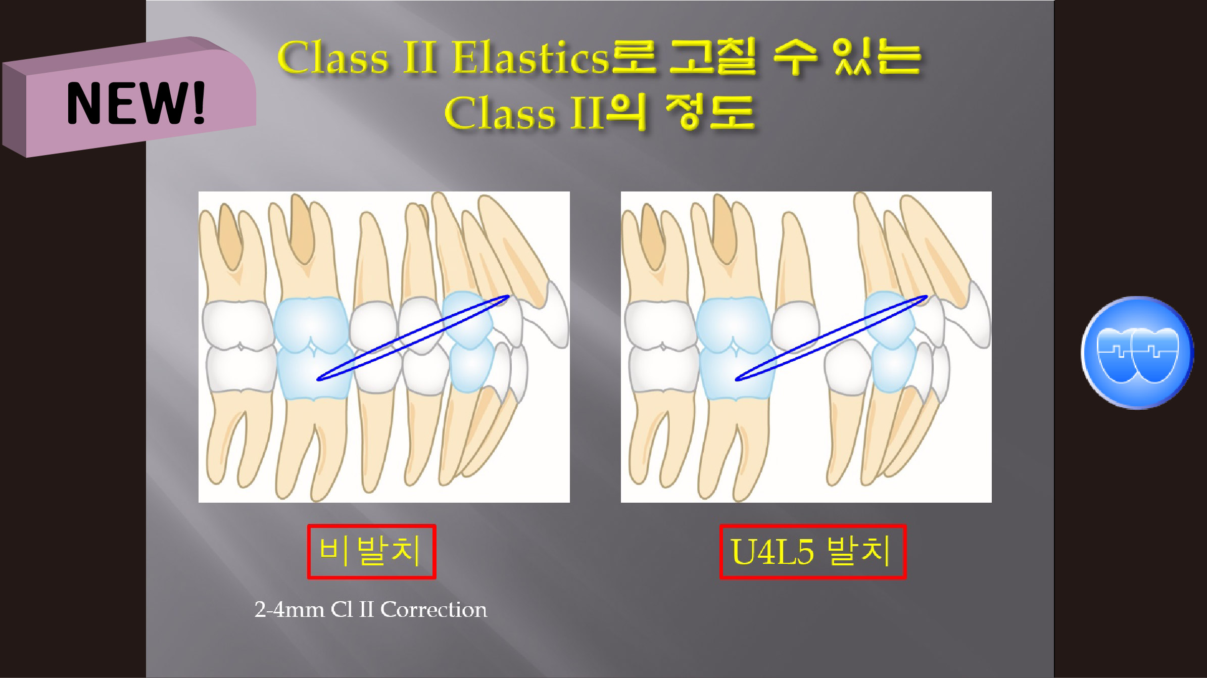 (강의 36) Sem #15  Class II. (Part III. Treatment Methods-Extraction)