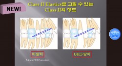 (강의 36) Sem #15  Class II. (Part III. Treatment Methods-Extraction)