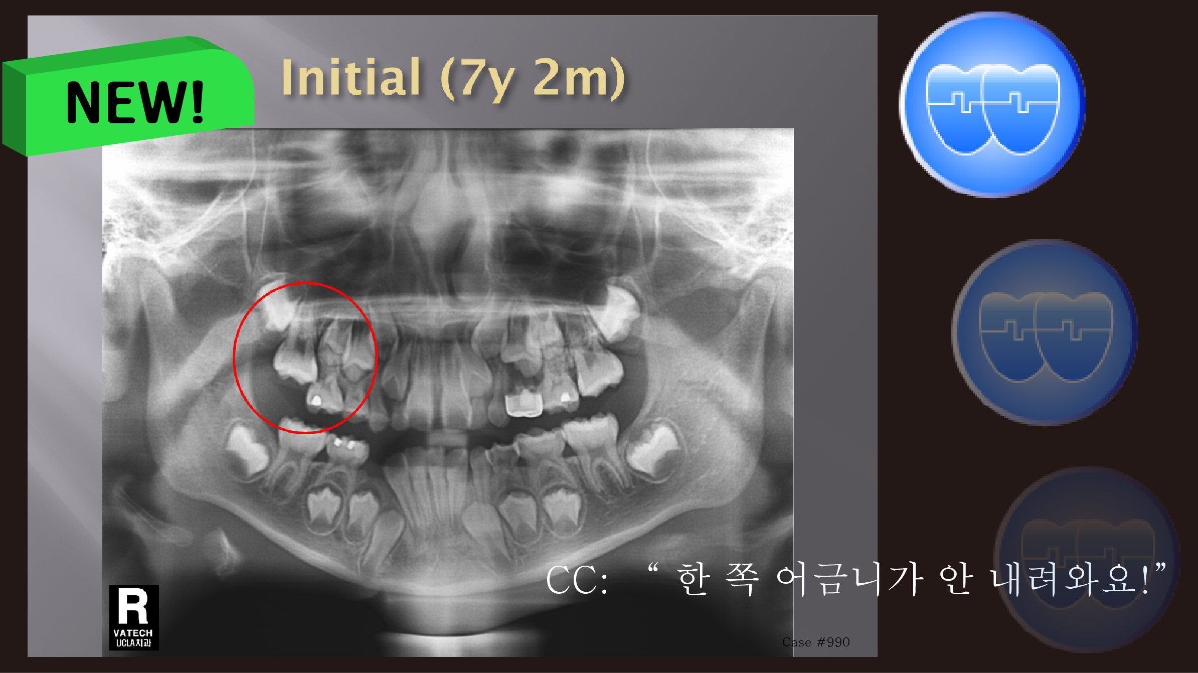 교정 Case 990.  1차 교정, Upper Molar Impaction.