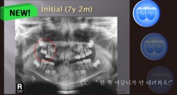 교정 Case 990.  1차 교정, Upper Molar Impaction.