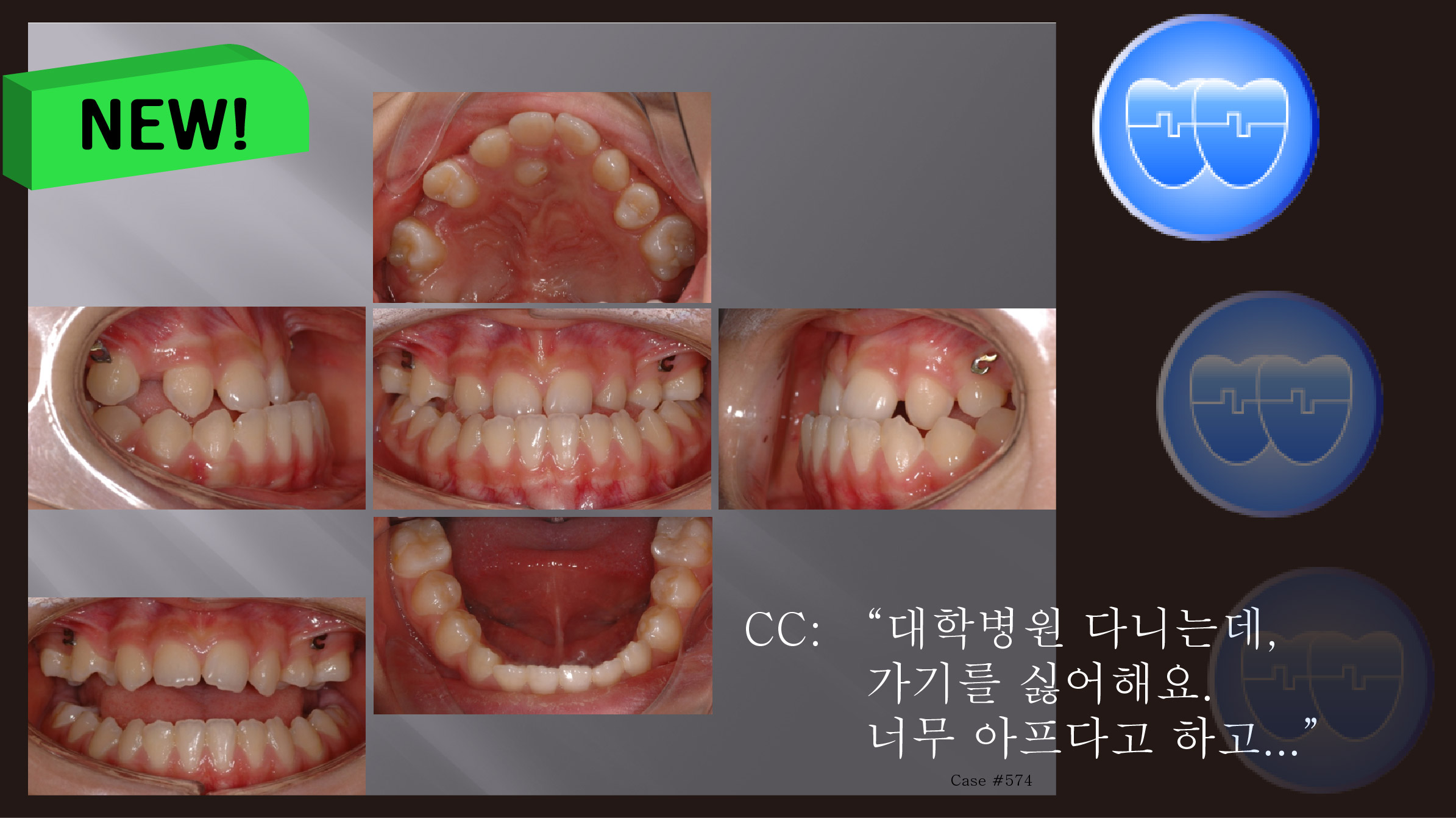 교정 Case 574.  Class III, Lower Lingual Corticotomy, Impaction of #24, Congenital Missing Teeth, Functional Shift, Sem #13.7