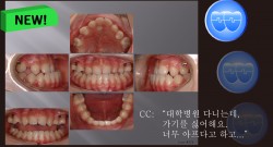 교정 Case 574.  Class III, Lower Lingual Corticotomy, Impaction of #24, Congenital Missing Teeth, Functional Shift, Sem #13.7