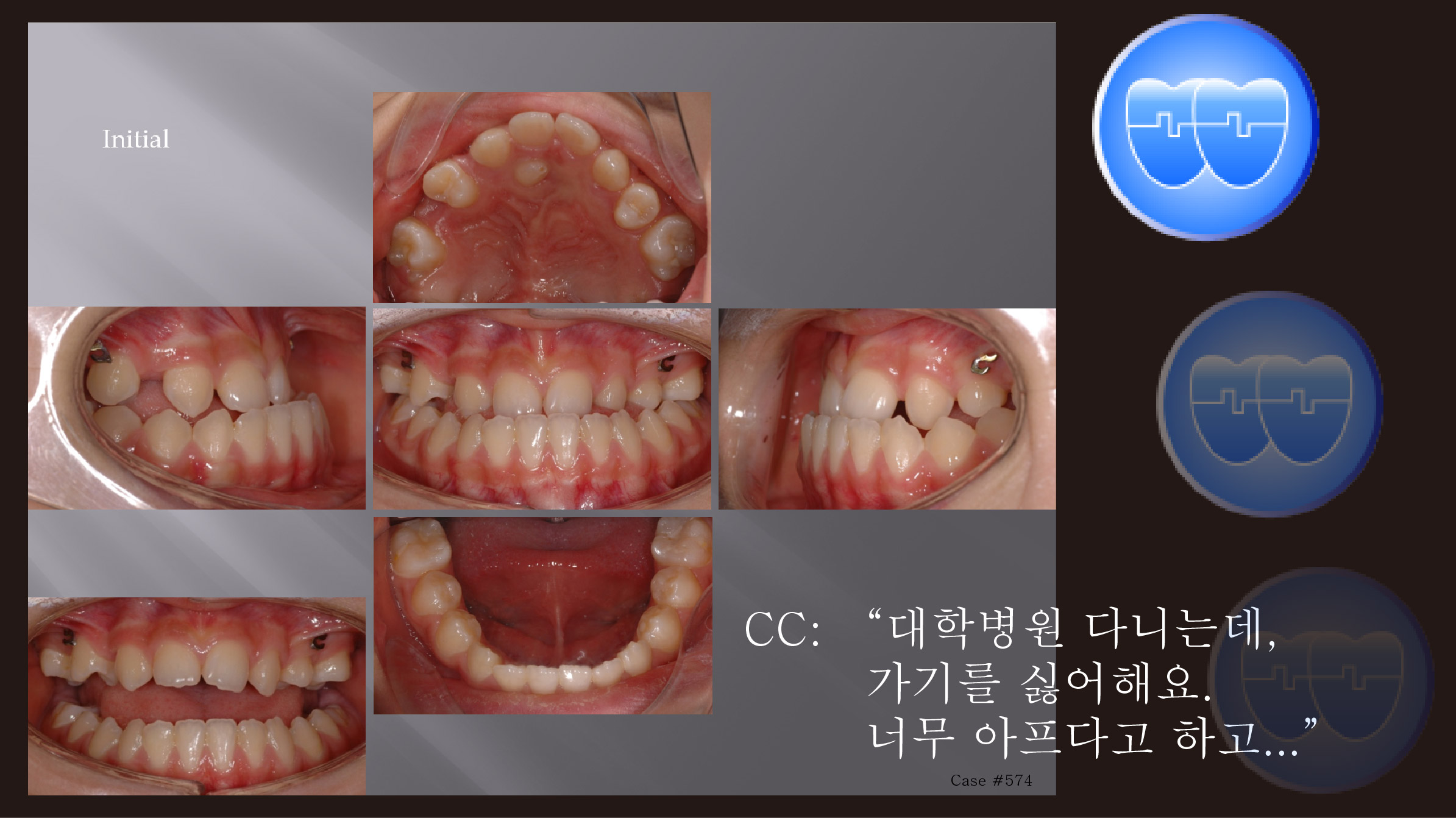 교정 Case 574.  Class III, Lower Lingual Corticotomy, Impaction of #24, Congenital Missing Teeth, Functional Shift, Sem #13.7