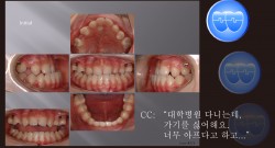 교정 Case 574.  Class III, Lower Lingual Corticotomy, Impaction of #24, Congenital Missing Teeth, Functional Shift, Sem #13.7