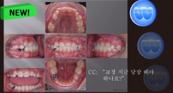 교정 Case 1145(1).  1차 교정, Anterior Crossbite, Advancing Z Arch, RHG, SS Open Coil Spring, Sem #9