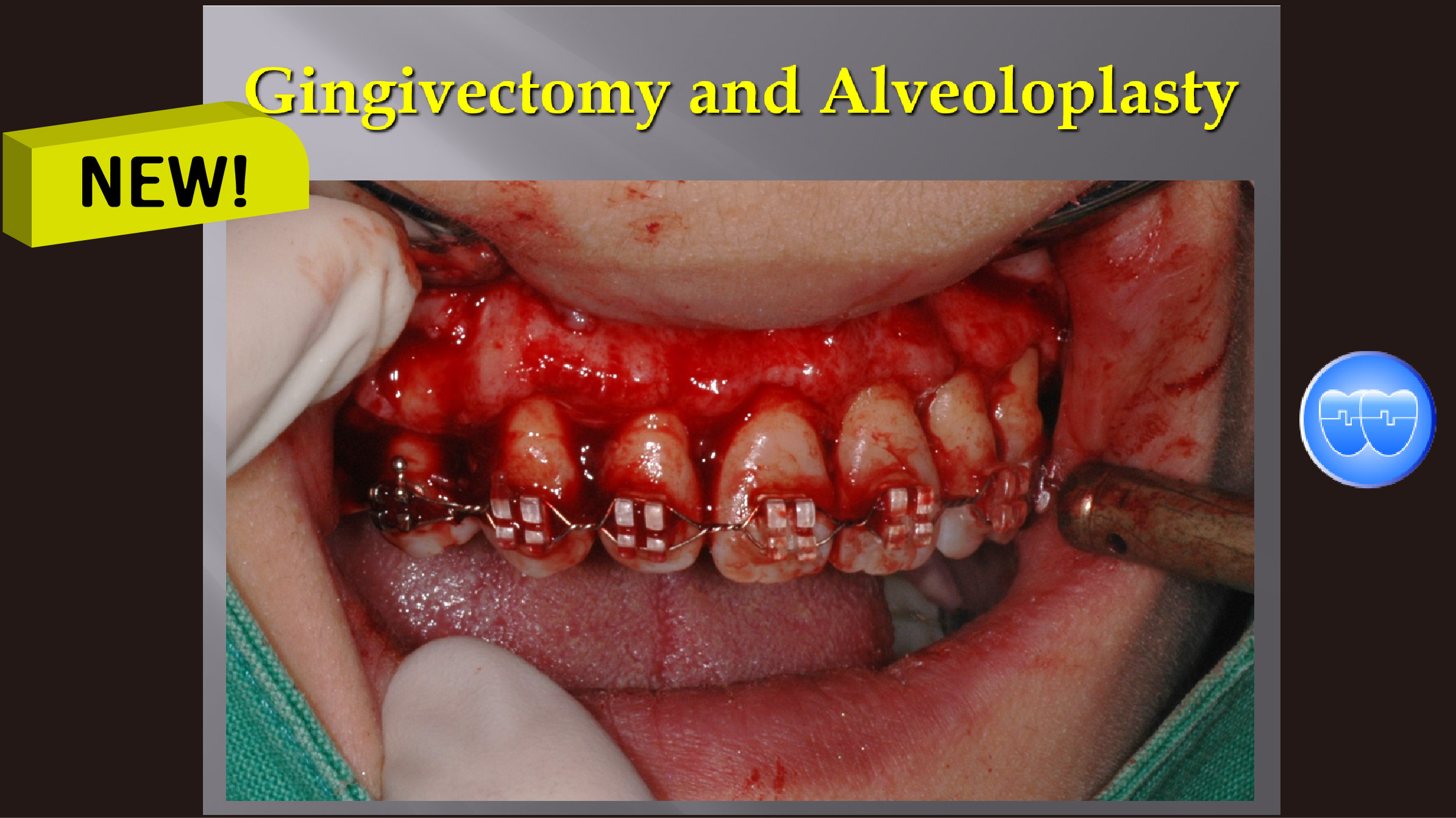 (실습 37) Gingivectomy and Alveoloplasty (New)