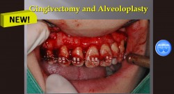 (실습 37) Gingivectomy and Alveoloplasty (New)