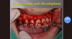 (실습 37) Gingivectomy and Alveoloplasty (New)