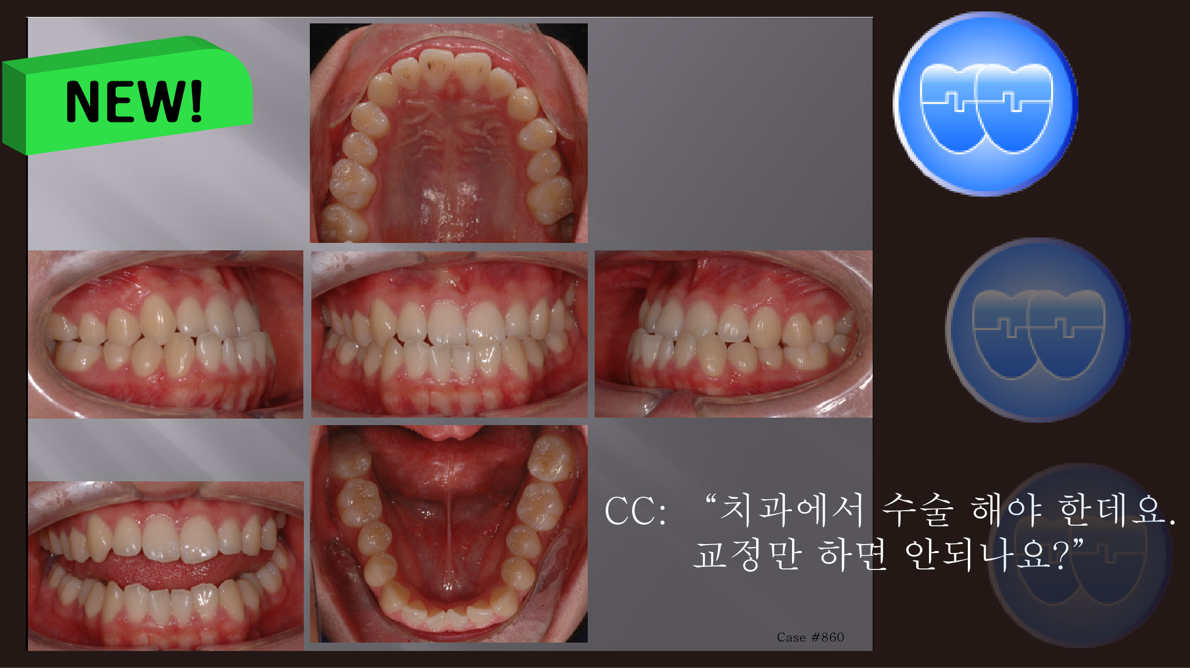 교정 Case 860.  Lower 4 발치, Functional Shift, Lower L. Cortidotomy, Sem #7.8