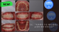 교정 Case 860.  Lower 4 발치, Functional Shift, Lower L. Cortidotomy, Sem #7.8