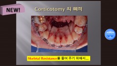 (강의 54) Corticotomy의 이해와 필요성, Sem #13.7