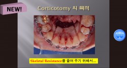 (강의 54) Corticotomy의 이해와 필요성, Sem #13.7