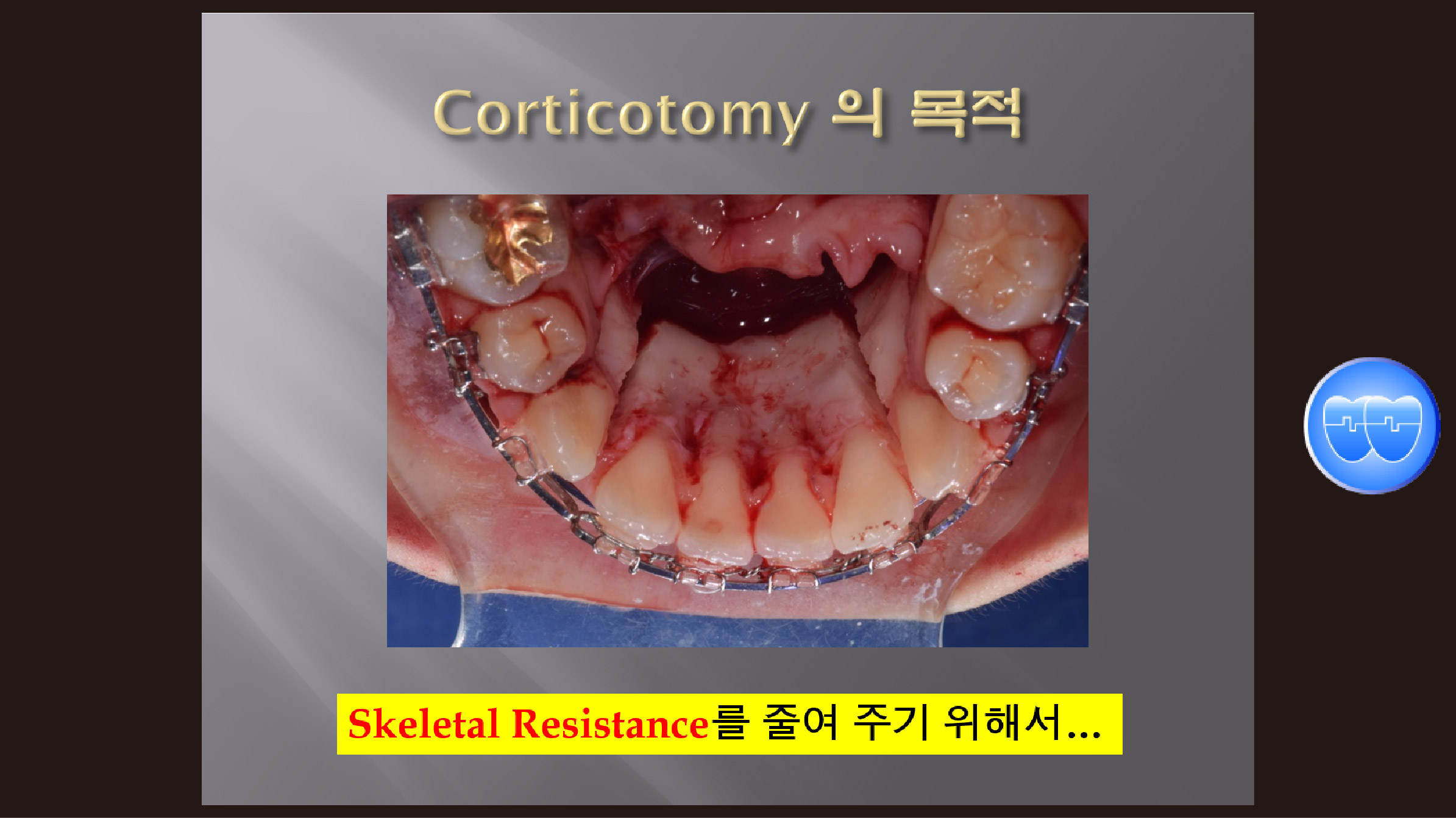 (강의 54) Corticotomy의 이해와 필요성, Sem #13.7