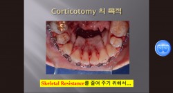 (강의 54) Corticotomy의 이해와 필요성, Sem #13.7