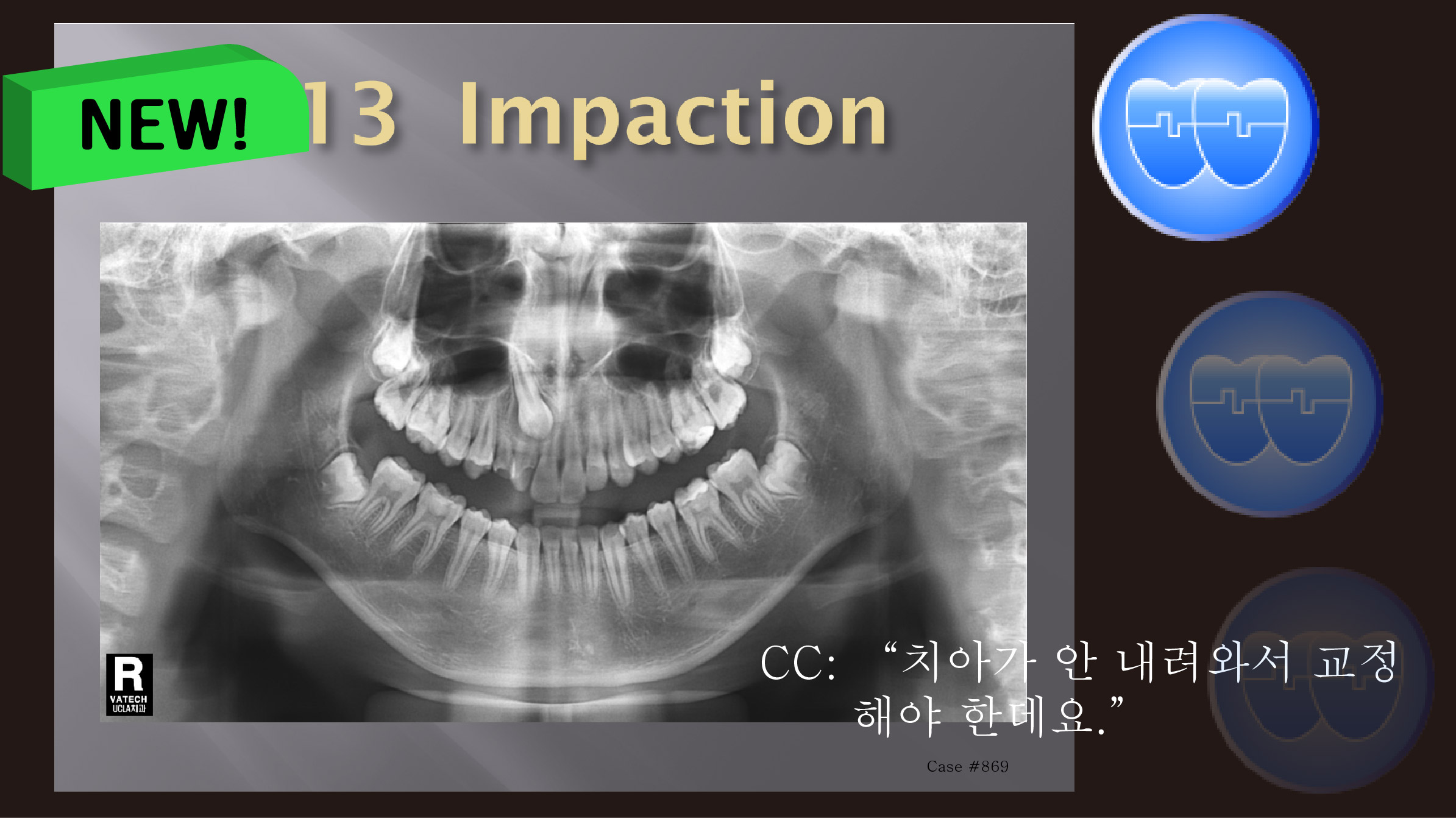 교정 Case 869.  비발치(L1 missing), Impacted Upper Canine, Root Resorption, Sem #14