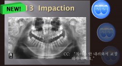 교정 Case 869.  비발치(L1 missing), Impacted Upper Canine, Root Resorption, Sem #14