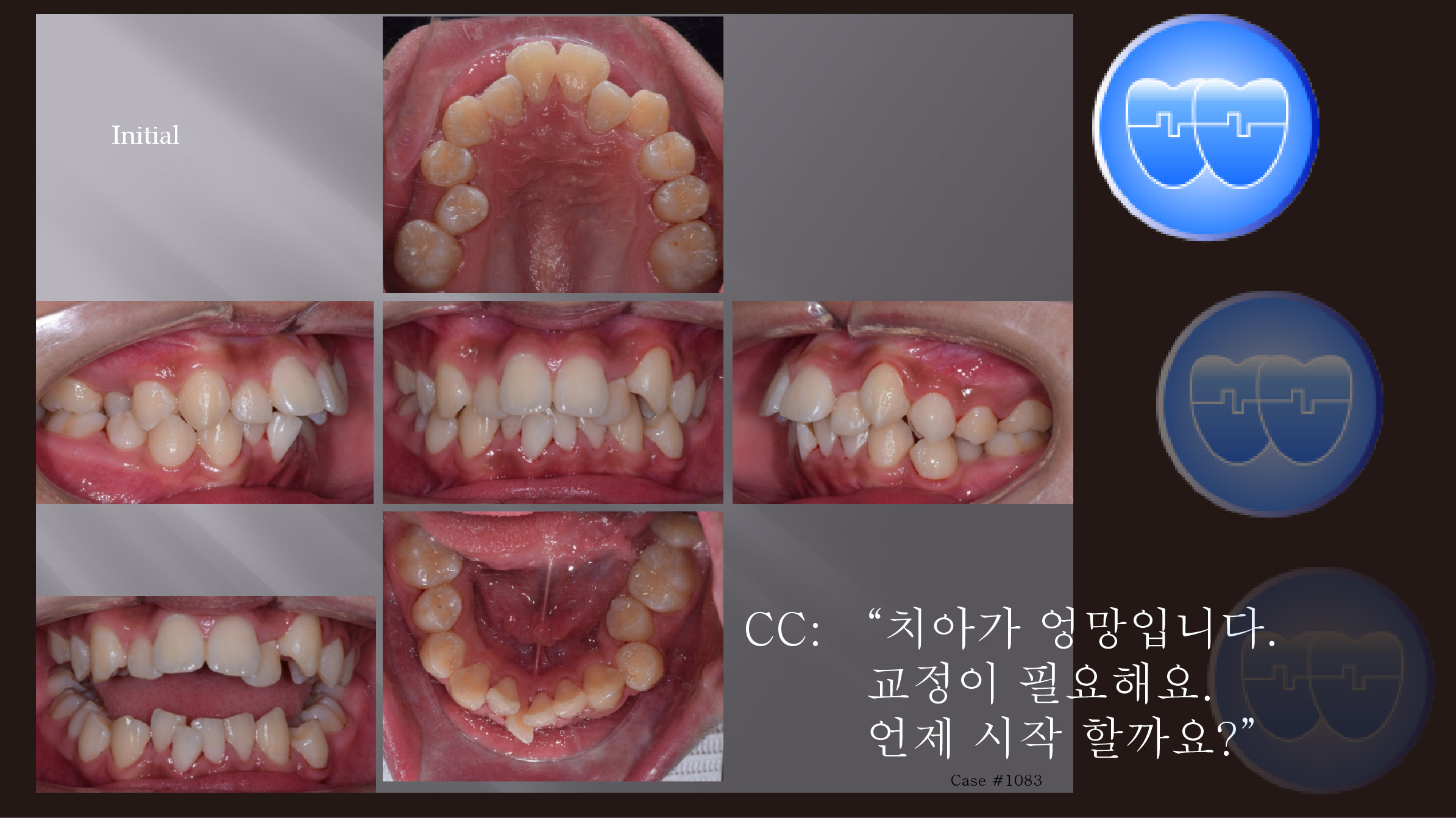 교정 Case 1083.  U5L5 발치, Sk. Class II, Severe Crowding, Finish 분석, Sem #12.4