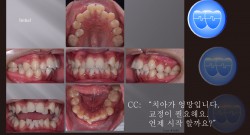 교정 Case 1083.  U5L5 발치, Sk. Class II, Severe Crowding, Finish 분석, Sem #12.4