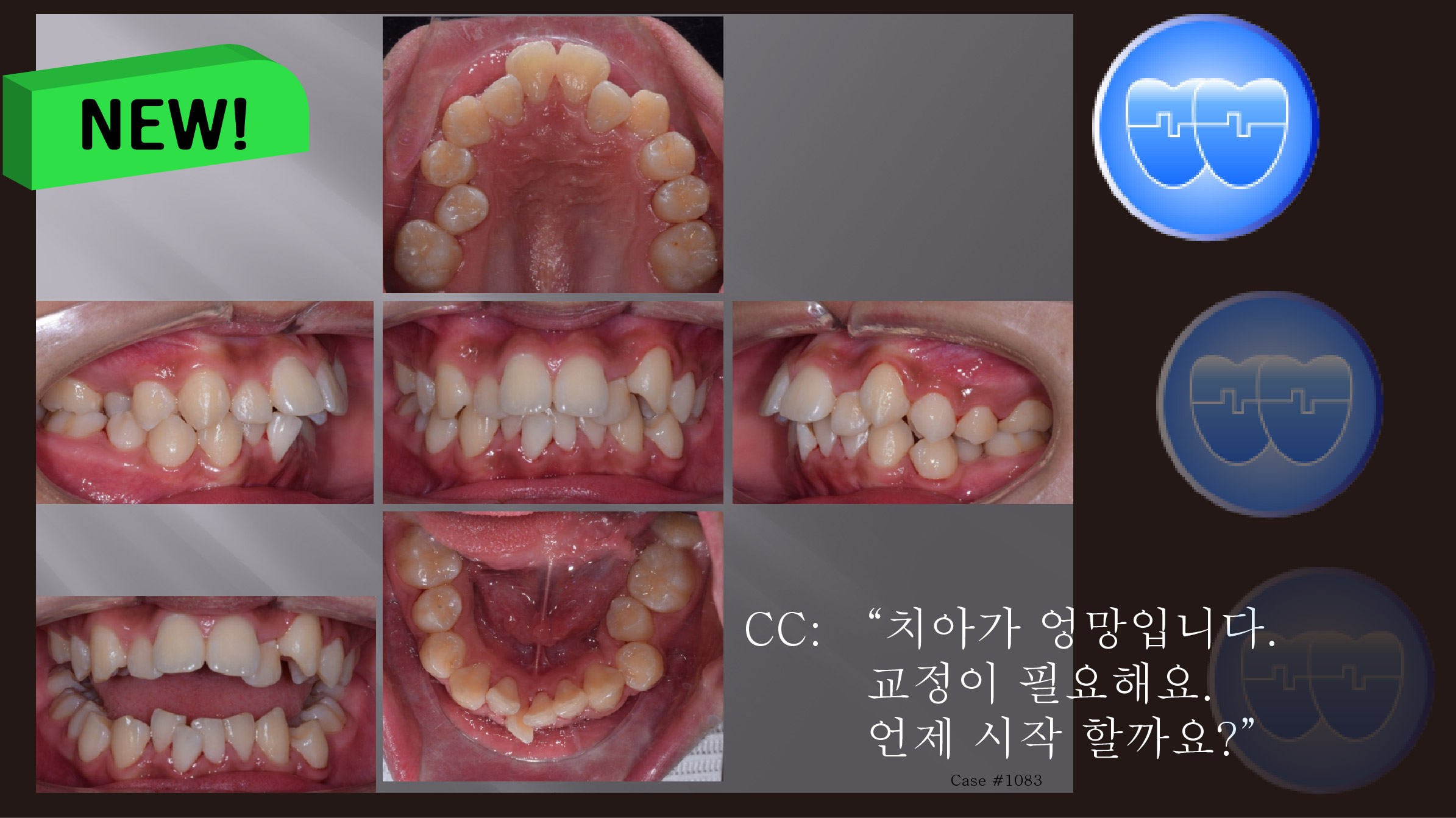 교정 Case 1083.  U5L5 발치, Sk. Class II, Severe Crowding, Finish 분석, Sem #12.4