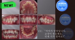 교정 Case 1083.  U5L5 발치, Sk. Class II, Severe Crowding, Finish 분석, Sem #12.4