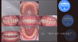 교정 Case 1047.  U5L5 발치, Skeletal Class II, Protrusion, Sem #12.4