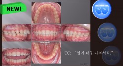 교정 Case 1047. U5L5 발치, Skeletal Class II, Protrusion, Sem #12.4