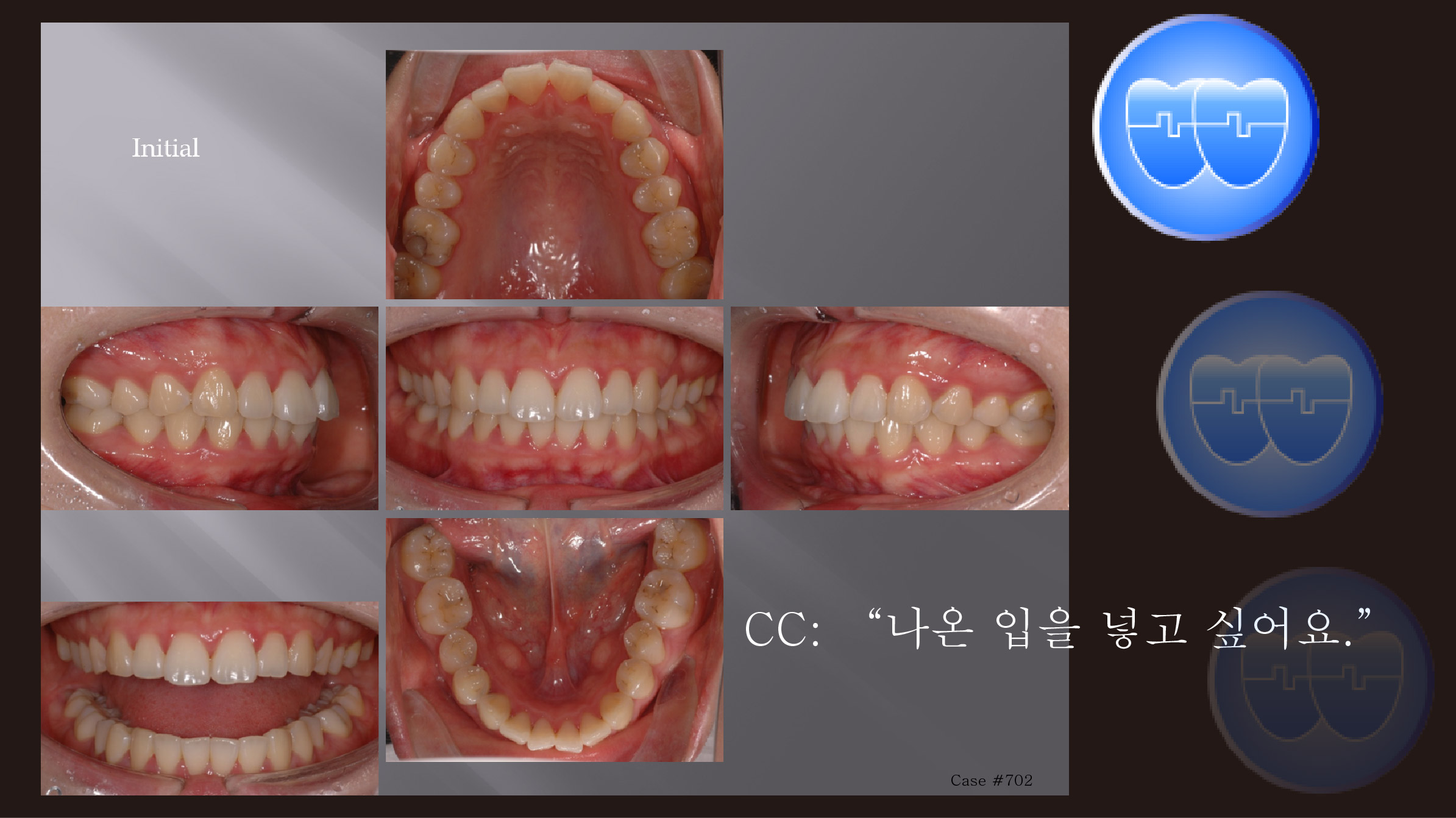 교정 Case 702.  U5L5 발치, Skeletal Class II, Protrusion, Sem #12.4