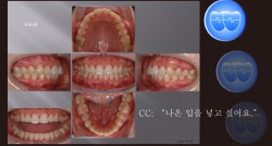 교정 Case 702.  U5L5 발치, Skeletal Class II, Protrusion, Sem #12.4