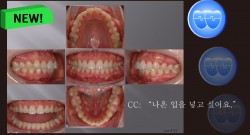 교정 Case 702. U5L5 발치, Skeletal Class II, Protrusion, Sem #12.4