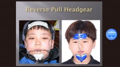 (실습 44) Reverse Pull Headgear(New)