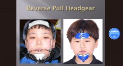 (실습 44) Reverse Pull Headgear(New)