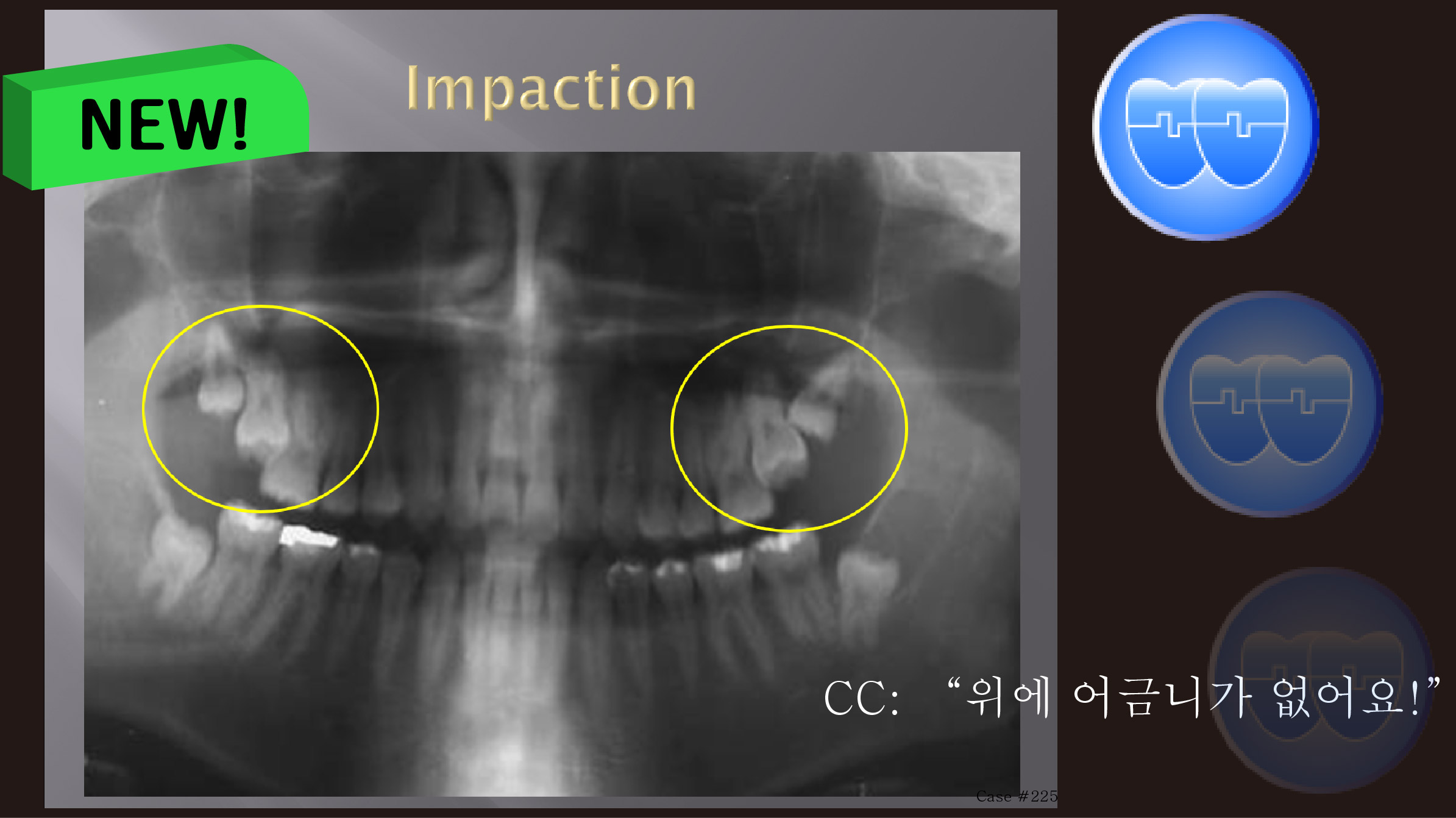 교정 Case 225. Impacted Upper 7번, 부분교정, Piggyback Wire Tech., Sem #14