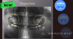 교정 Case 225. Impacted Upper 7번, 부분교정, Piggyback Wire Tech., Sem #14