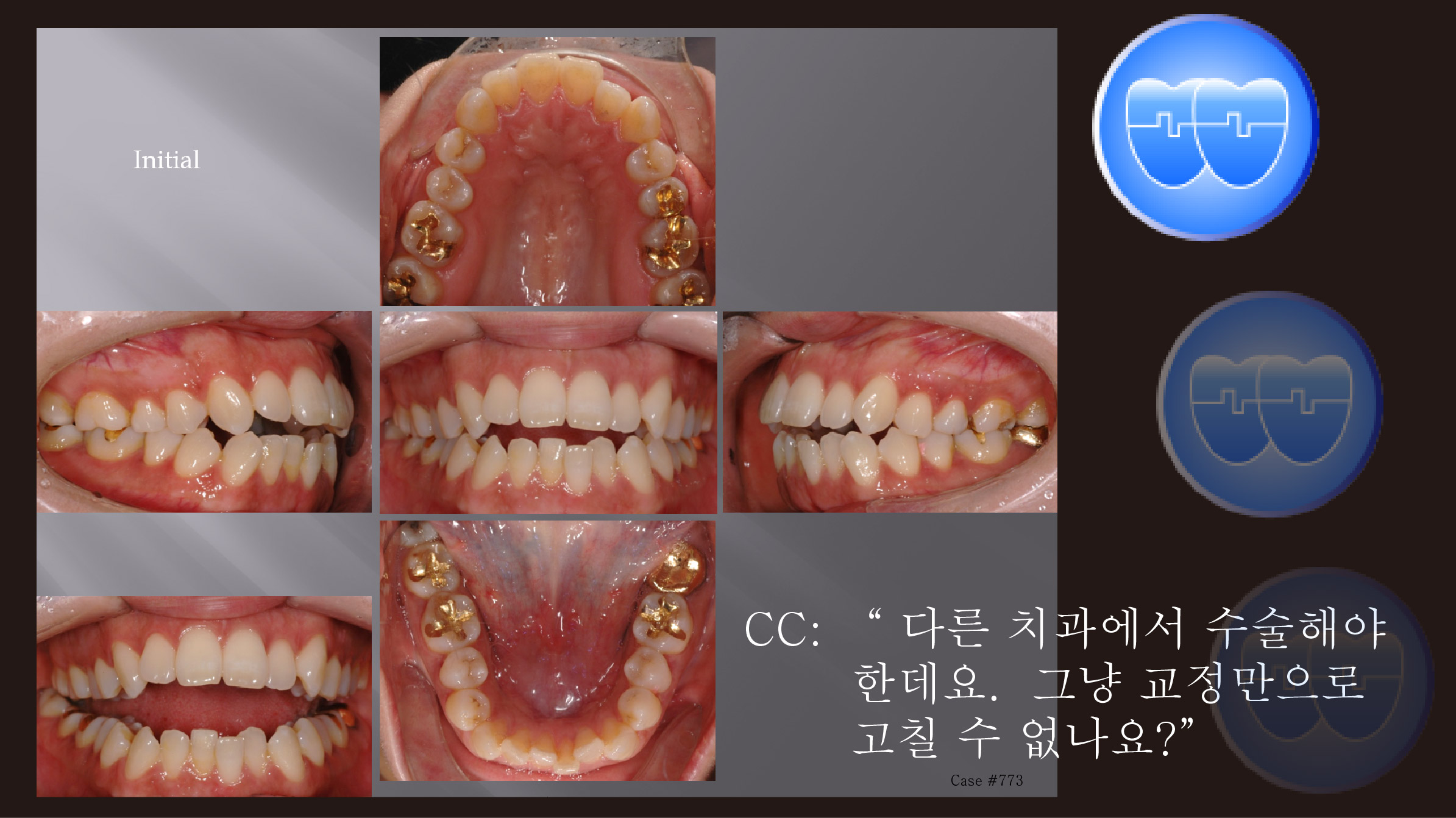 교정 Case 773. U5L5 발치, Dental Openbite, Sem #7(New,SyL로고)