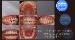 교정 Case 773. U5L5 발치, Dental Openbite, Sem #7(New,SyL로고)