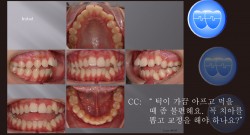 교정 Case 697.  U5L5 발치, Skeletal Class II, TMJ, Molar Intrusion to Close Open bite, Sem #19