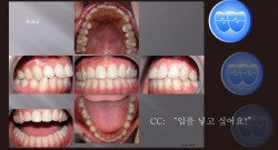 교정 Case 26.  U4L4 발치, Protrusion, Mechanics 진행 실수, Sem #12.1