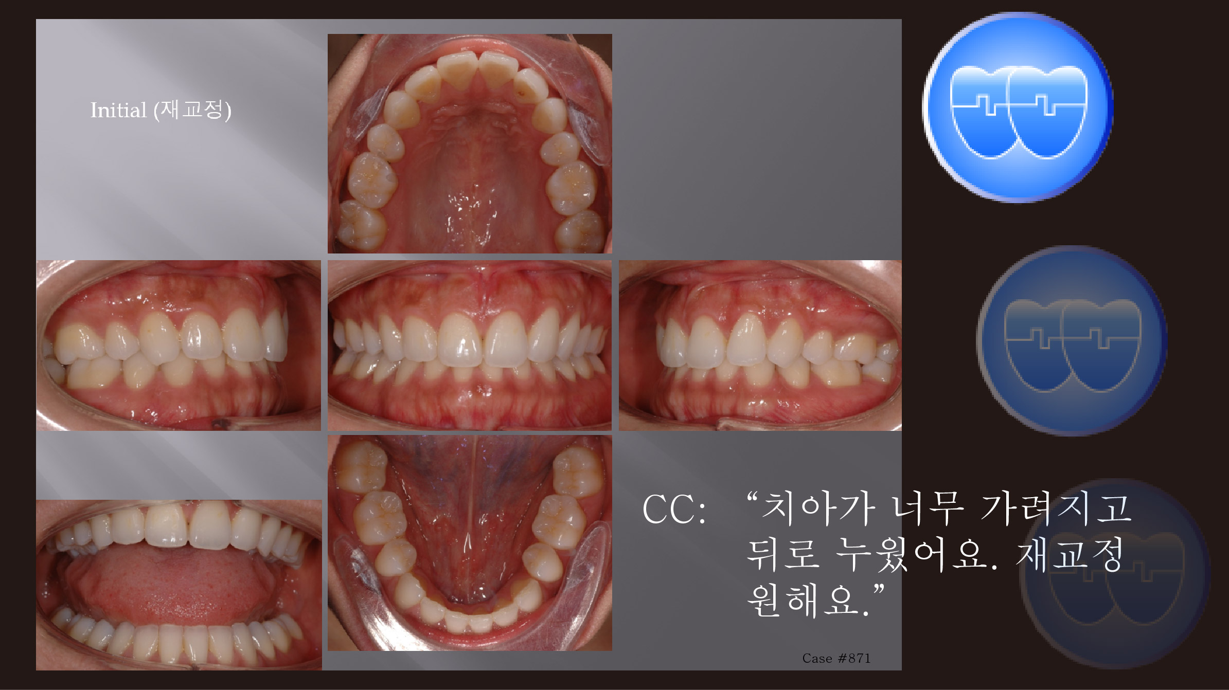 교정 Case 871.  재교정(Case 26연결), Gummy Smile, Deepbite, Detorqued Incisors, Sem #12.1