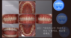 교정 Case 871.  재교정(Case 26연결), Gummy Smile, Deepbite, Detorqued Incisors, Sem #12.1