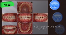 교정 Case 805.  Lower 4 발치, Dental Openbite, Lower Lingual Corticotomy, Sem #13.7