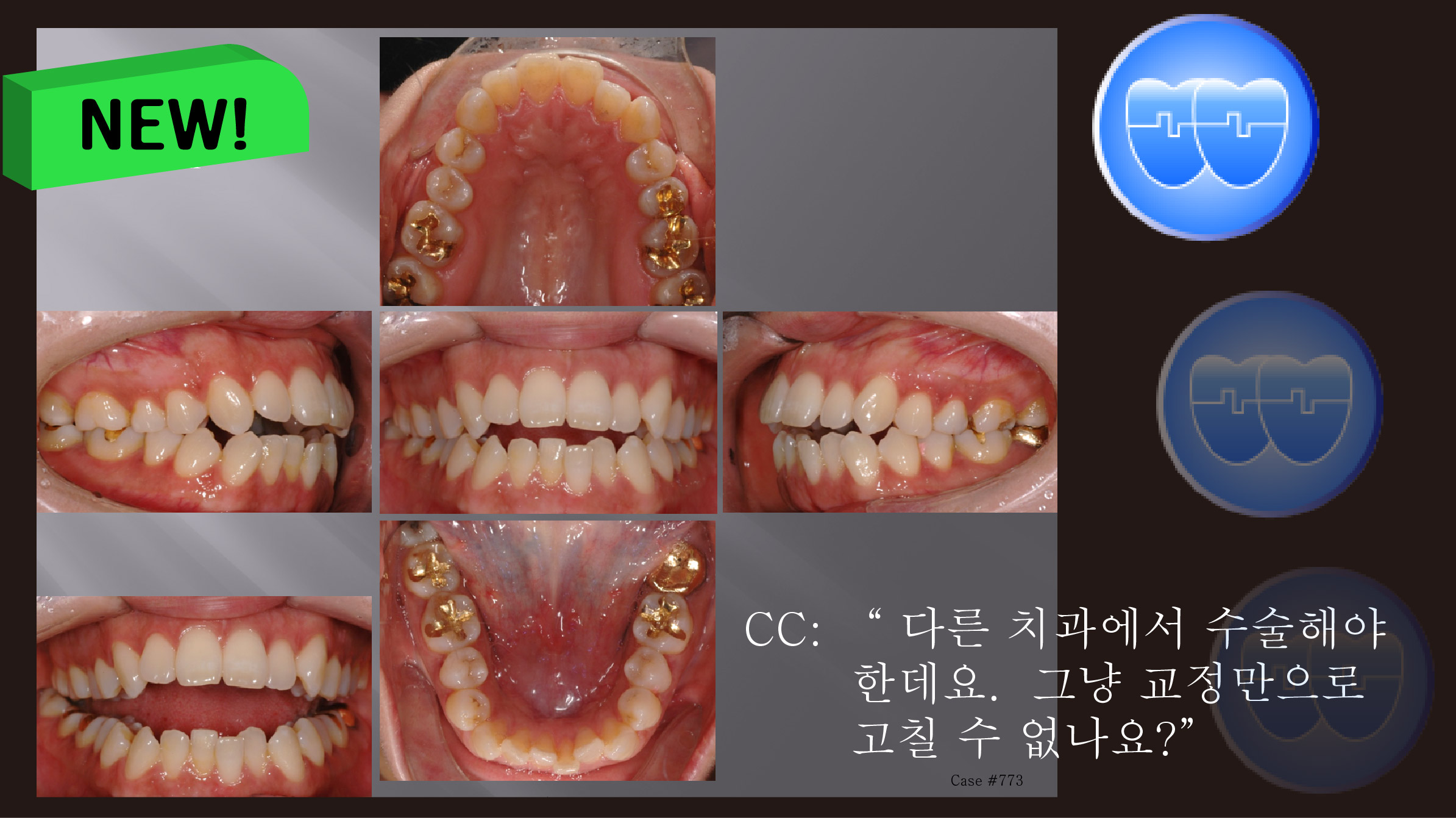 교정 Case 773.  U5L5 발치, Dental Openbite, Sem #7